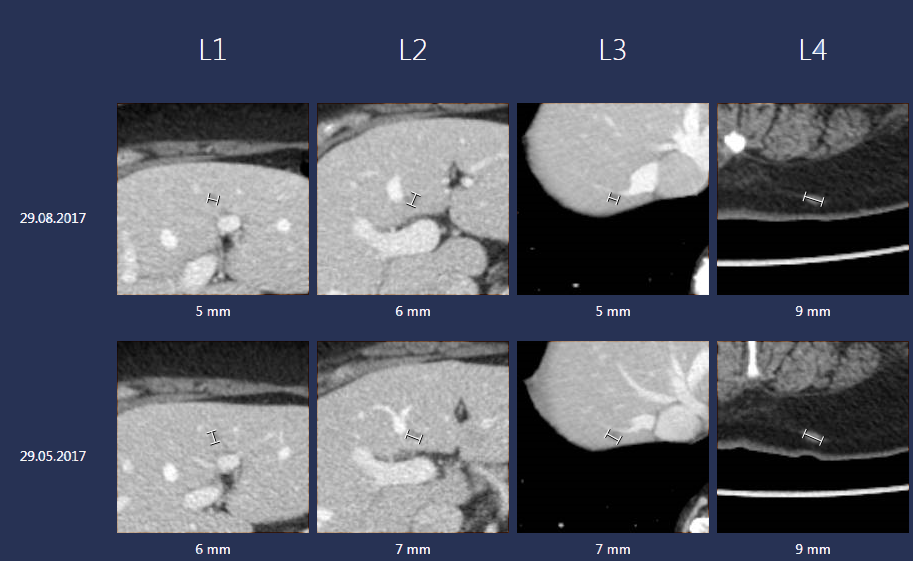 A screenshot of the Sectra Lesion Tracking tool