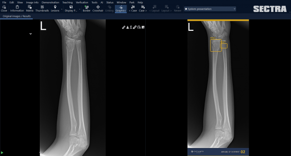 AI applicatie Gleamer Boneview in Sectra PACS