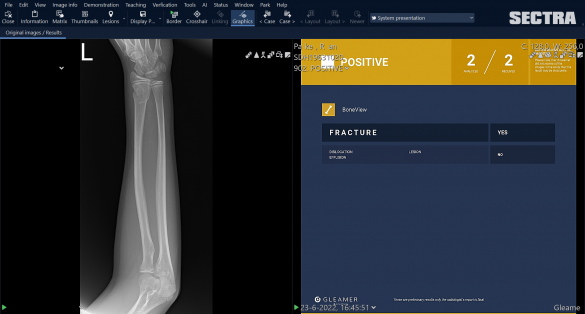 AI applicatie Gleamer Boneview in Sectra PACS
