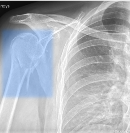 Humerus fracture