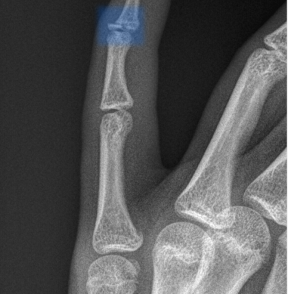 Distal phalange fracture
