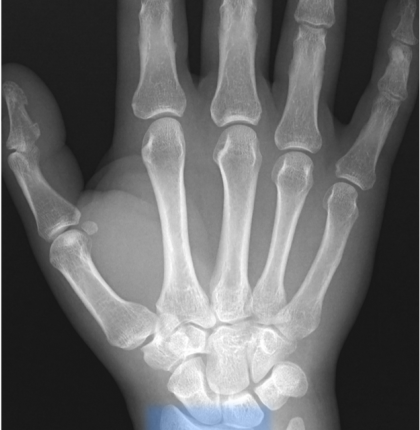 Distal radial fracture