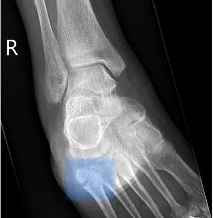 Fracture of the proximal fifth metatarsal
